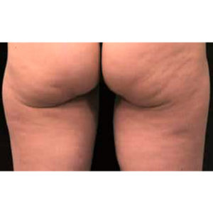 Tratamiento de la celulitis en glúteos, antes y después