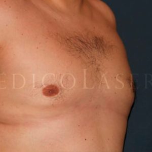 Antes y después de la operación de ginecomastia en Madrid