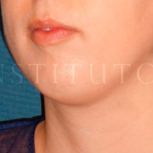 Antes y después del Lipo en papada de IML
