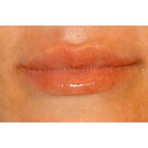 Perfilado labial antes y después