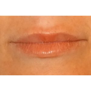 Perfilado labial antes y después