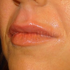 Imágenes del antes y después de un Perfilado de labios