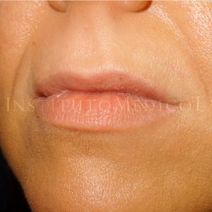 Imágenes del antes y después de un Perfilado de labios