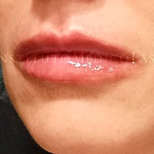 Perfilado de labios, antes y después