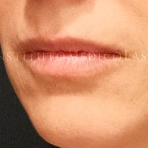 Perfilado de labios, antes y después