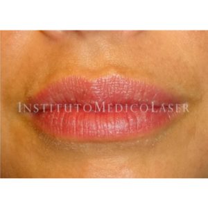 Perfilado de labios con ácido hialurónico, antes y después