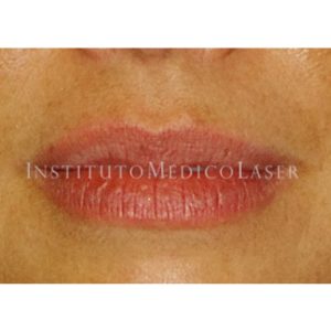 Perfilado de labios con ácido hialurónico, antes y después