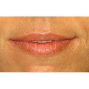 Perfilado y aumento de labios, antes y después