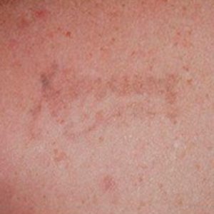 Eliminar tatuajes - antes y después de 1 sesión con Picosure