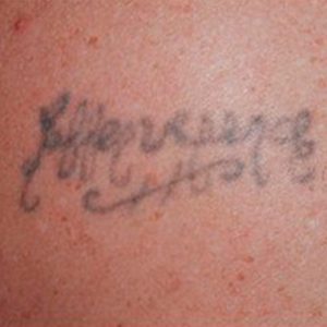 Eliminar tatuajes - antes y después de 1 sesión con Picosure
