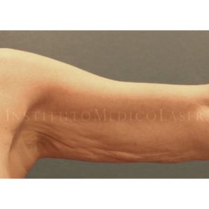 Plasma de helio ionizado en brazos, antes y después