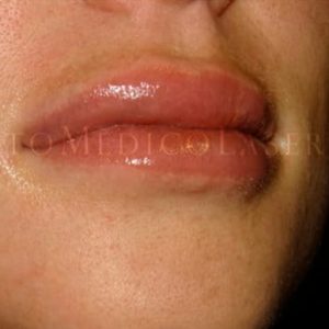 Antes y después del aumento de labios