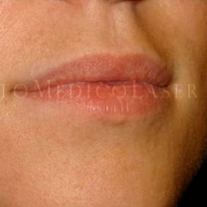 Antes y después del aumento de labios
