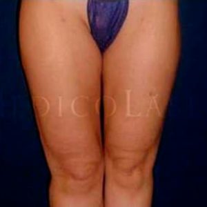 Antes y después de Lipoláser en muslos y rodillas