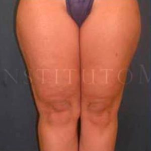 Antes y después de Lipoláser en muslos y rodillas