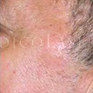 Queratosis seborreica, fotos del antes y después