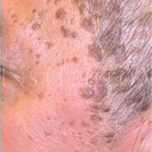 Queratosis seborreica, fotos del antes y después