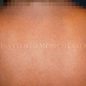 Queratosis seborreica, antes y después