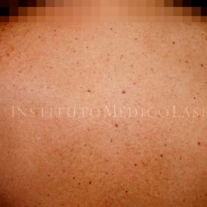 Queratosis seborreica, antes y después