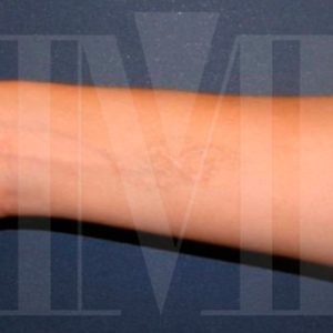 Eliminación de tatuaje con láser en brazo: foto de antes y después