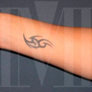 Eliminación de tatuaje con láser en brazo: foto de antes y después