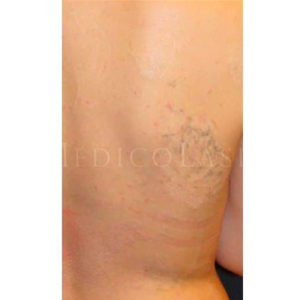 Antes y después de eliminar tatuajes de color