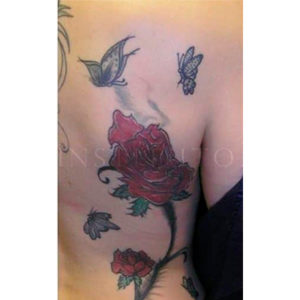 Antes y después de eliminar tatuajes de color