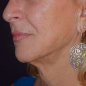 Flacidez en cara y cuello, antes y después de Morpheus8