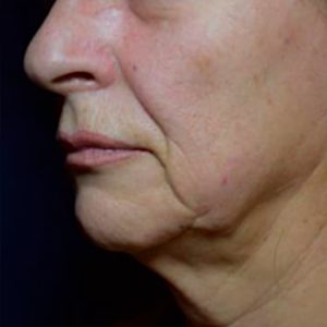 Flacidez en cara y cuello, antes y después de Morpheus8