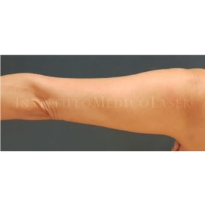 Antes y después de reafirmar brazos con Renuvion
