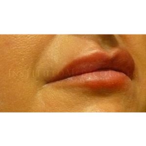 Antes y después del Rejuvenecimiento de labios con ácido hialurónico