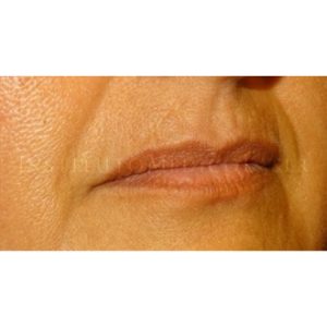 Antes y después del Rejuvenecimiento de labios con ácido hialurónico