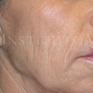Rejuvenecimiento facial con láser CO2, antes y después