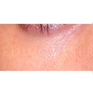 Relleno de ojeras con ácido hialurónico, antes y después