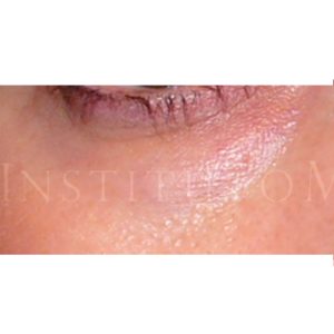 Relleno de ojeras con ácido hialurónico, antes y después