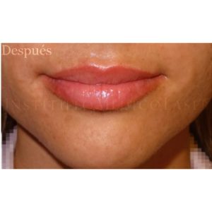 Imágenes antes y después del Relleno de labios