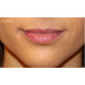Imágenes antes y después del Relleno de labios