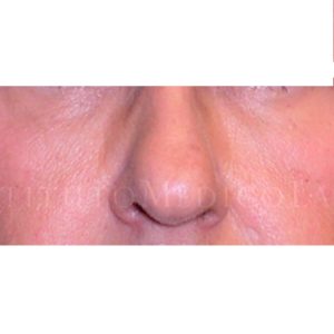 Relleno del tercio medio facial, antes y después