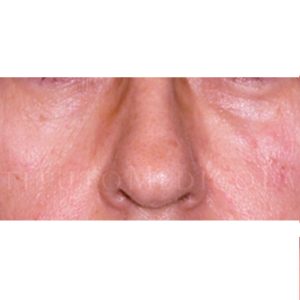 Relleno del tercio medio facial, antes y después