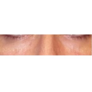Relleno para el tratamiento de ojeras, antes y después