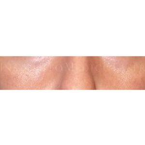 Relleno para el tratamiento de ojeras, antes y después