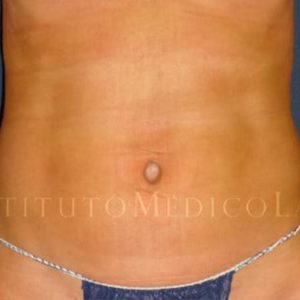 Renuvion en abdomen