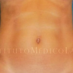 Renuvion en abdomen