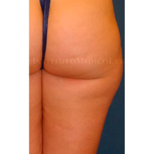 Renuvion Jplasma en cartucheras, antes y después