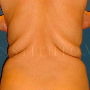 Renuvion Jplasma en espalda, antes y después