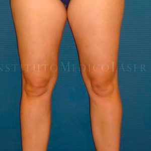 Antes y después de Renuvion Lipohelio en piernas