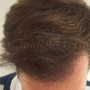 Resultado natural antes y después en Injerto Capilar