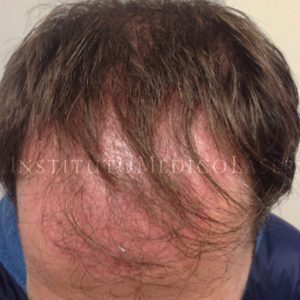 Resultado natural antes y después en Injerto Capilar
