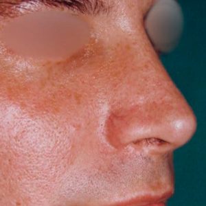 Resultados de la Rinoplastia en hombres, antes y después
