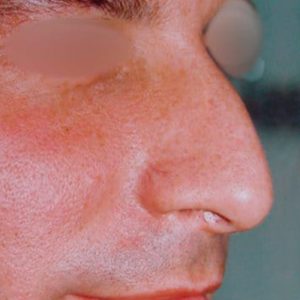 Resultados de la Rinoplastia en hombres, antes y después